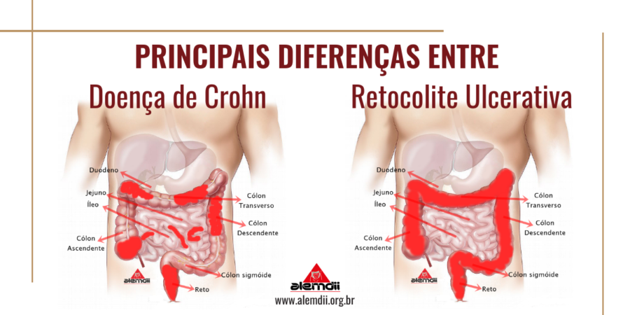 Principais diferenças entre a Doença de Crohn e a Retocolite Ulcerativa